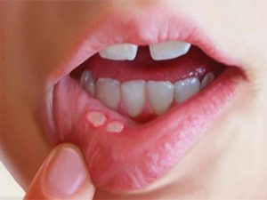زخم‌های دردناک دهان از کجا می‌آیند؟/ دلایل شایع و راه‌های کاهش درد و پیشگیری