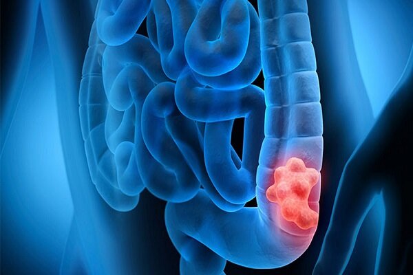 شناسایی علائم هشدار دهنده مولکولی اولیه بیماری التهابی روده - خبرگزاری مهر | اخبار ایران و جهان