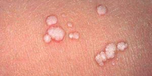 ویروس زگیل از باشگاه ورزشی منتقل می‌شود؟